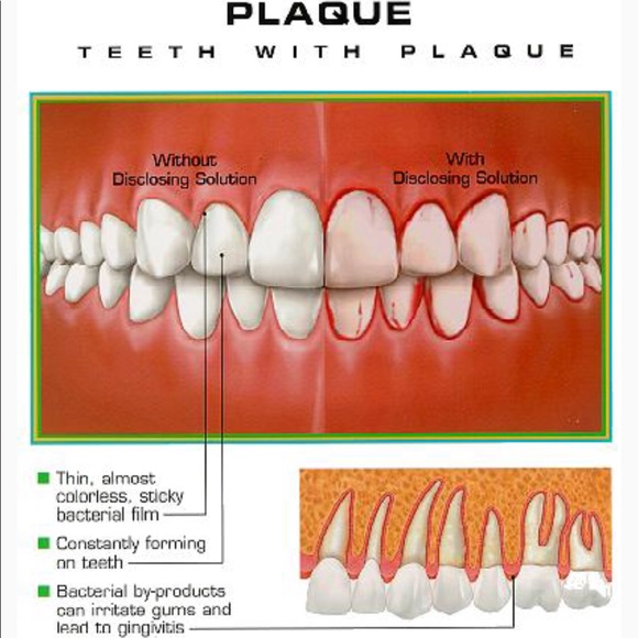 Electric Dental Calculus and Tartar Remover NEW - Picture 6 of 8